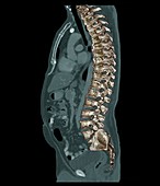 Bony spurs and arthritic spine,3D CT scan