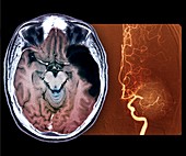 Stroke,MRI brain scan