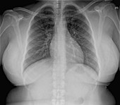 Heart and lungs in obesity,chest X-ray