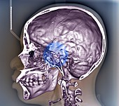 Human skull,3D CT scan