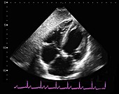 Normal heart,ultrasound scan