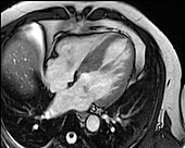 Heart hypertrophy,axial MRI angiogram