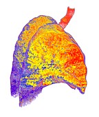 Interstitial lung disease,3D CT scan