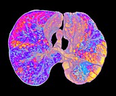 Emphysema lung disease,3D CT scan