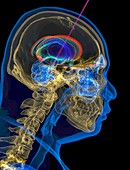 Deep brain stimulation,3D CT-based image