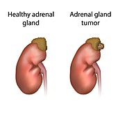 Adrenal gland tumour and healthy adrenal gland,illustration
