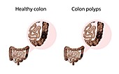 Colon polyps and healthy colon,illustration