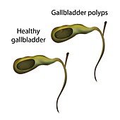 Gallbladder polyps and healthy gallbladder,illustration