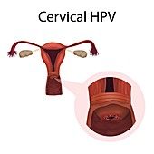 Cervical HPV infection,illustration