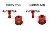 Nabothian cysts and healthy cervix,illustration