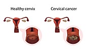 Cervical cancer and healthy cervix,illustration