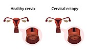 Cervical ectopy and healthy cervix,illustration