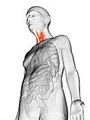 Illustration of an elderly man's thyroid