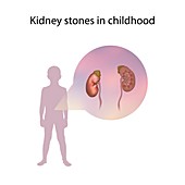 Kidney stones in childhood,illustration