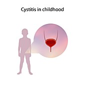 Cystitis in childhood,illustration