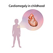 Cardiomegaly in childhood,illustration
