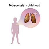 Tuberculosis in childhood,illustration