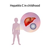 Hepatitis C in childhood,illustration