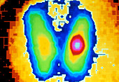 Coloured gamma scan of benign thyroid adenoma