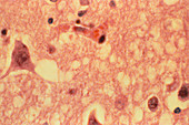 LM of human brain with Creutzfeldt-Jakob disease