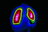 F/colour gamma scan of healthy human lungs