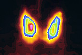Coloured Gamma Scan of normal human thyroid gland