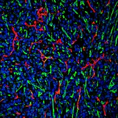 Breast cancer tumour tissue, confocal light micrograph