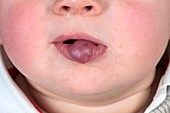 Haemangioma on a child's lip