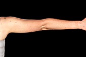 Congenital moles on the arm