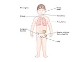 Childhood diseases, illustration