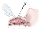 Cricothyrotomy airway puncture, illustration