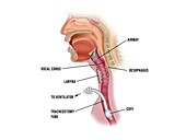 Tracheostomy airway tube, illustration