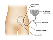 Peritoneal dialysis, illustration