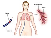 Pulmonary embolism, illustration