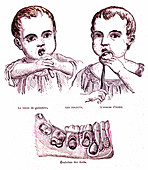 Teething and child teeth development, 19th century