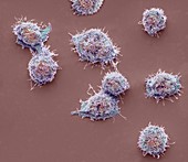 Lymphoma cancer cells, SEM
