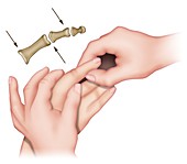 Hypermobile finger joints, illustration