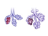 Lung diseases and alveoli, illustration