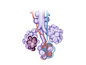Damaged alveoli in lung disease, illustration