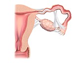 Fallopian tube obstruction, illustration