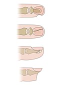 Fingertip injuries, illustration