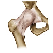 Femoral hip fracture, illustration