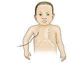 Child with chest drain, illustration