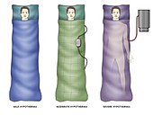 Hypothermia treatments, illustration