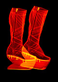 Wedge knee-high boots, X-ray