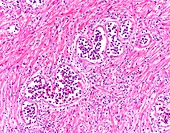 Intravascular large B-cell lymphoma, light micrograph