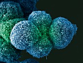 Pancreatic cancer cells, SEM