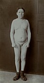 Intersex person, historical image