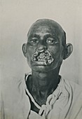 Facial disfigurement, historical image