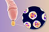 Gonorrhoea infection in male, illustration
